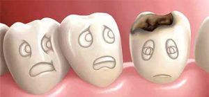 علت پوسیدگی دندان ها
